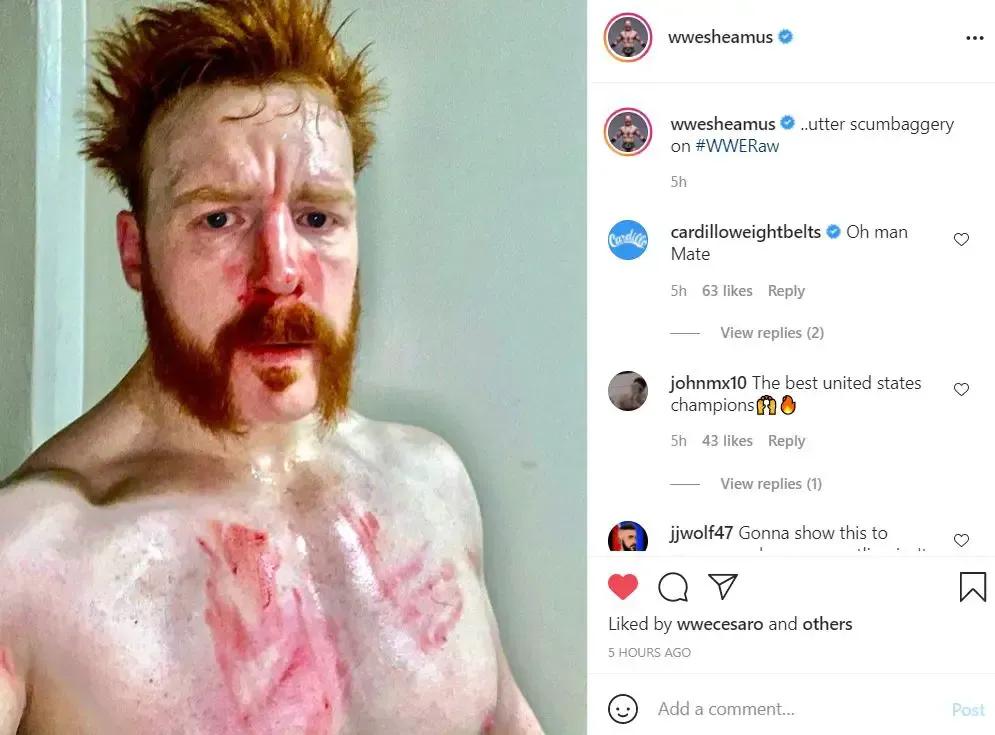 Sheamus broken nose instagram
